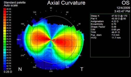 Corneal topography map showing axial curvature in astigmatism