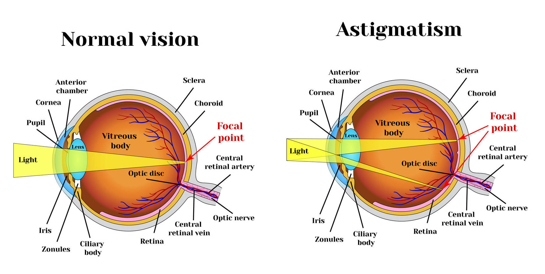 Vision training exercises for astigmatism