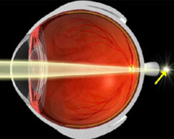Cross-section of a farsighted eye focusing light behind the retina