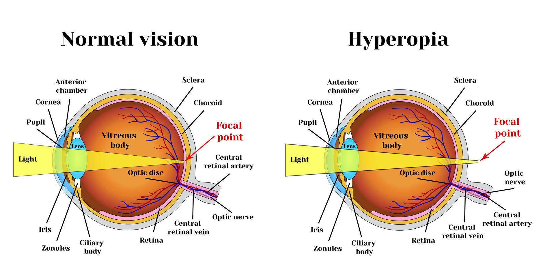 Vision training exercises for hyperopia (farsightedness)