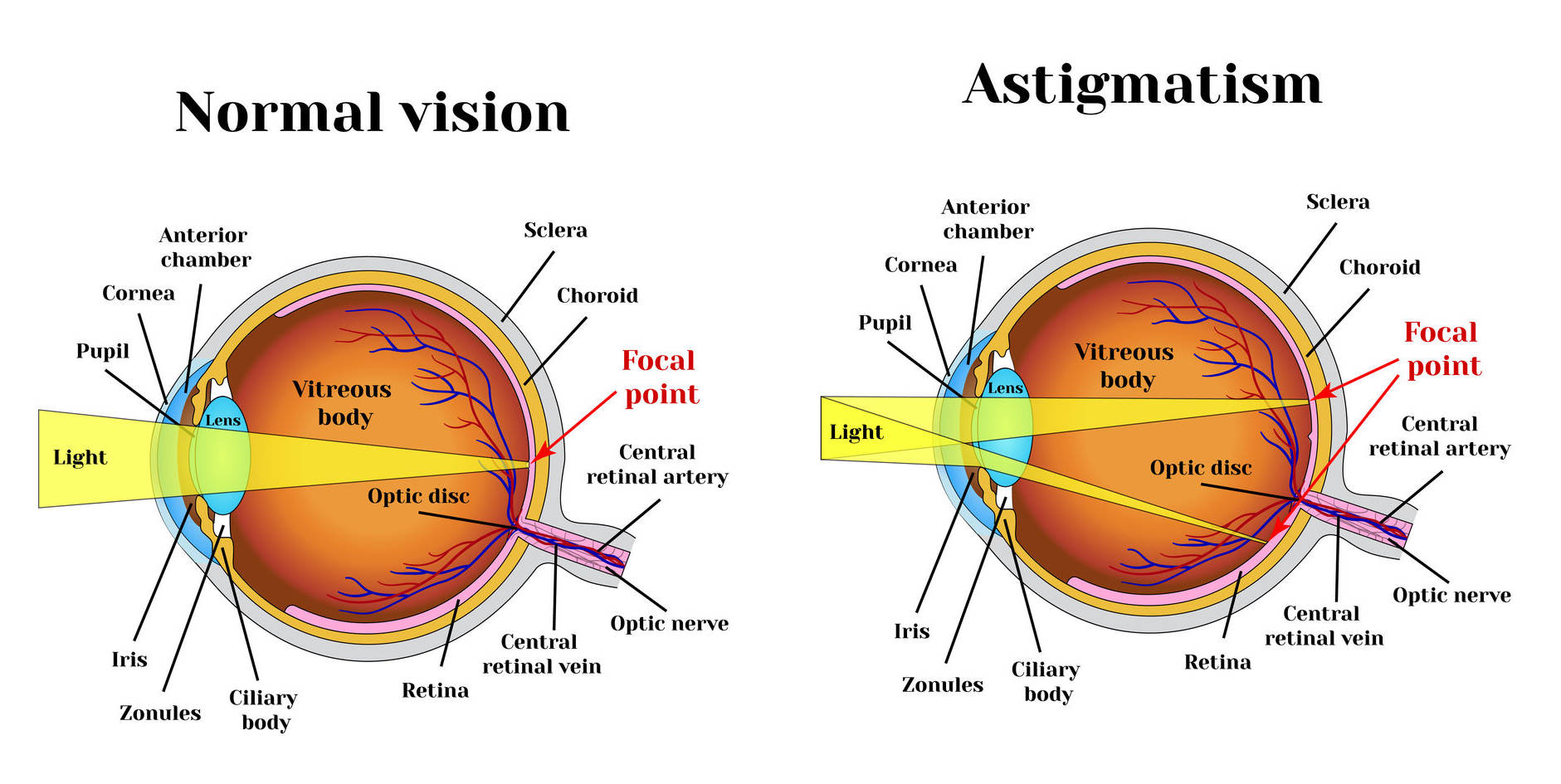 Myopia astigmatizmus csecsemőknél, Hyperopia myopia astigmatizmus