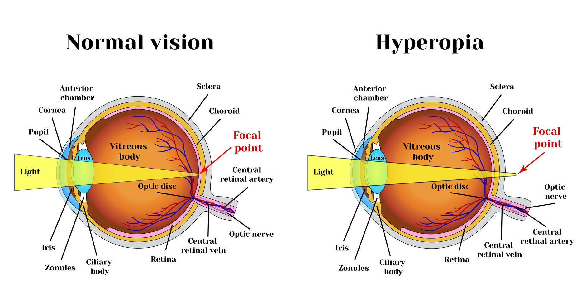 Presbyopia Eye Exercise Chart