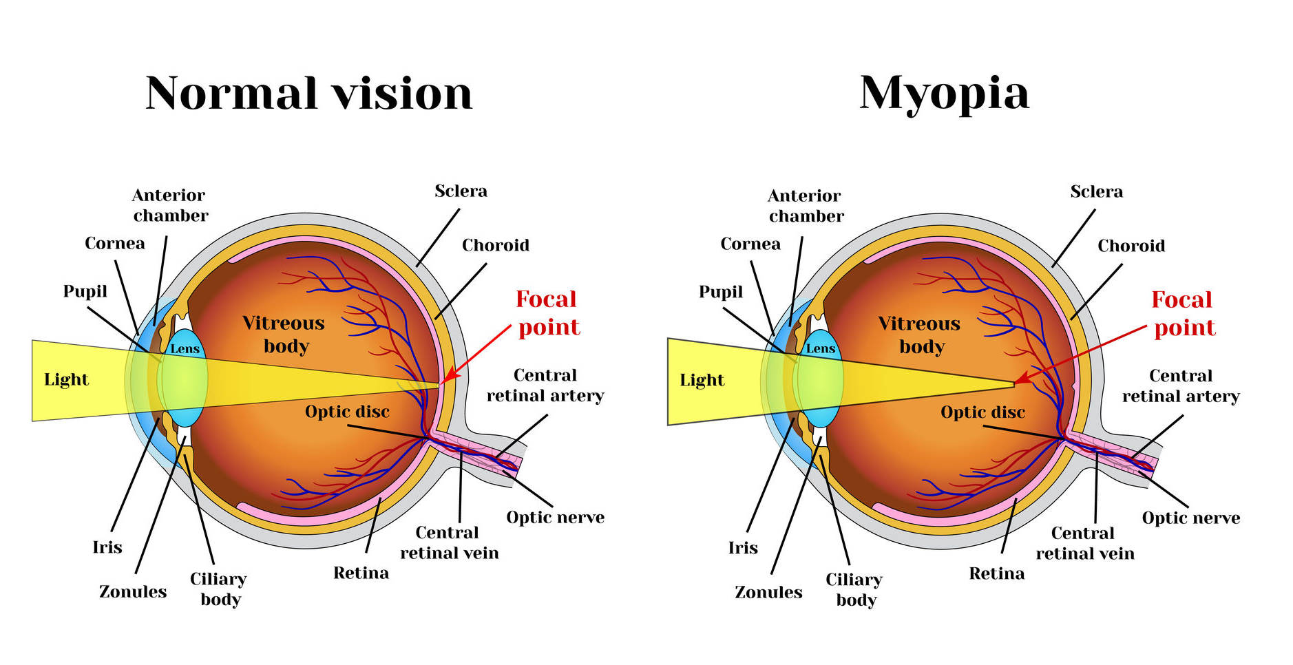 Presbyopia Reduction Chart